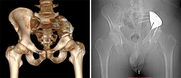 3D-печатный имплант тазобедренного сустава